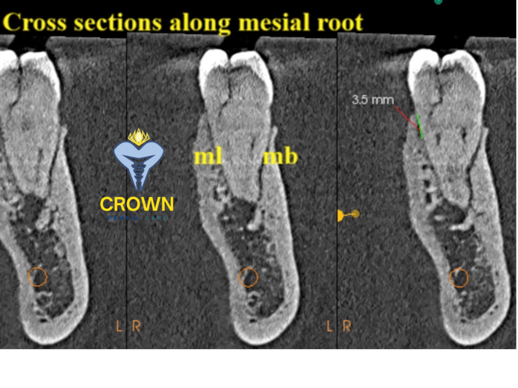 Implant placement diagram