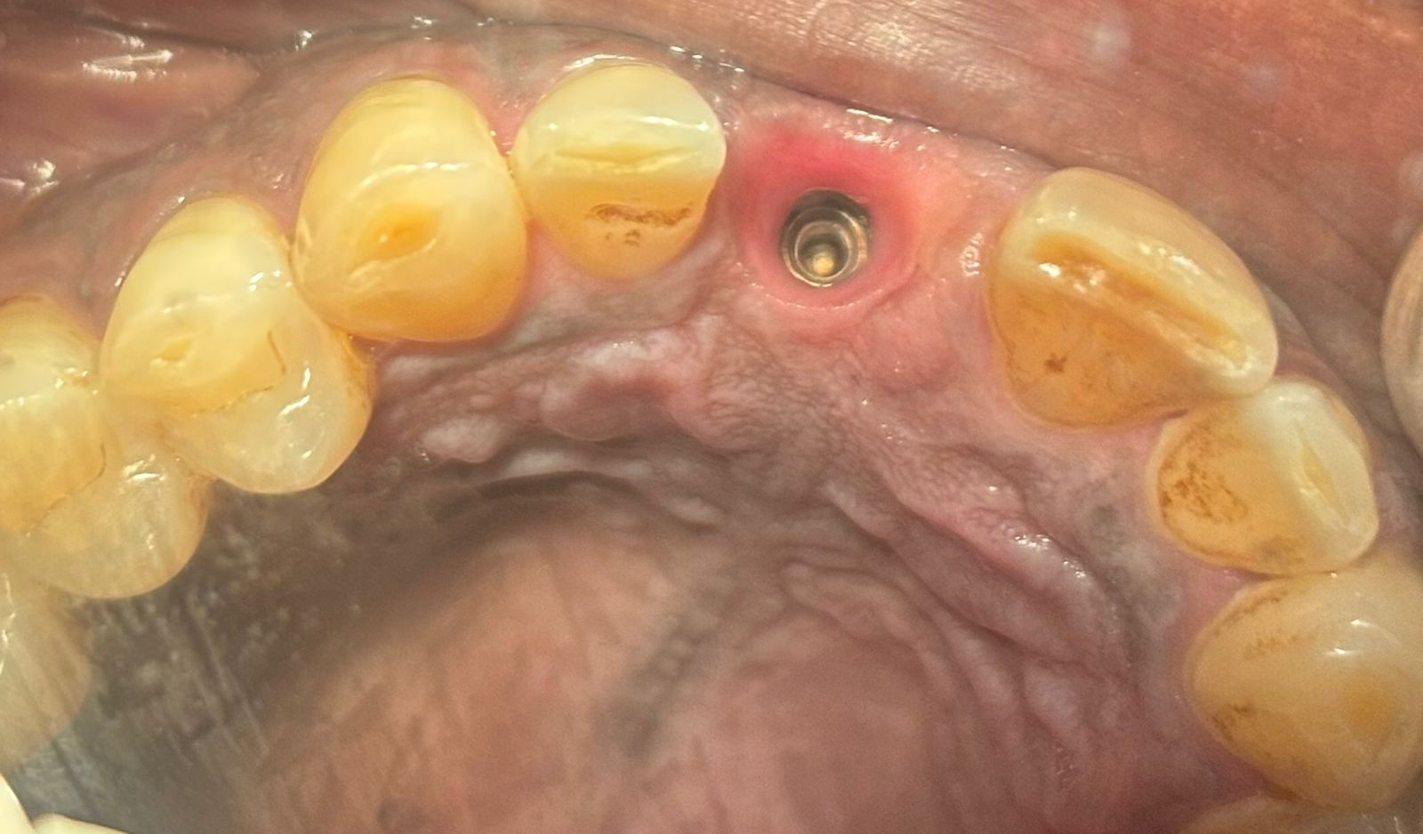 Implant bone with screw