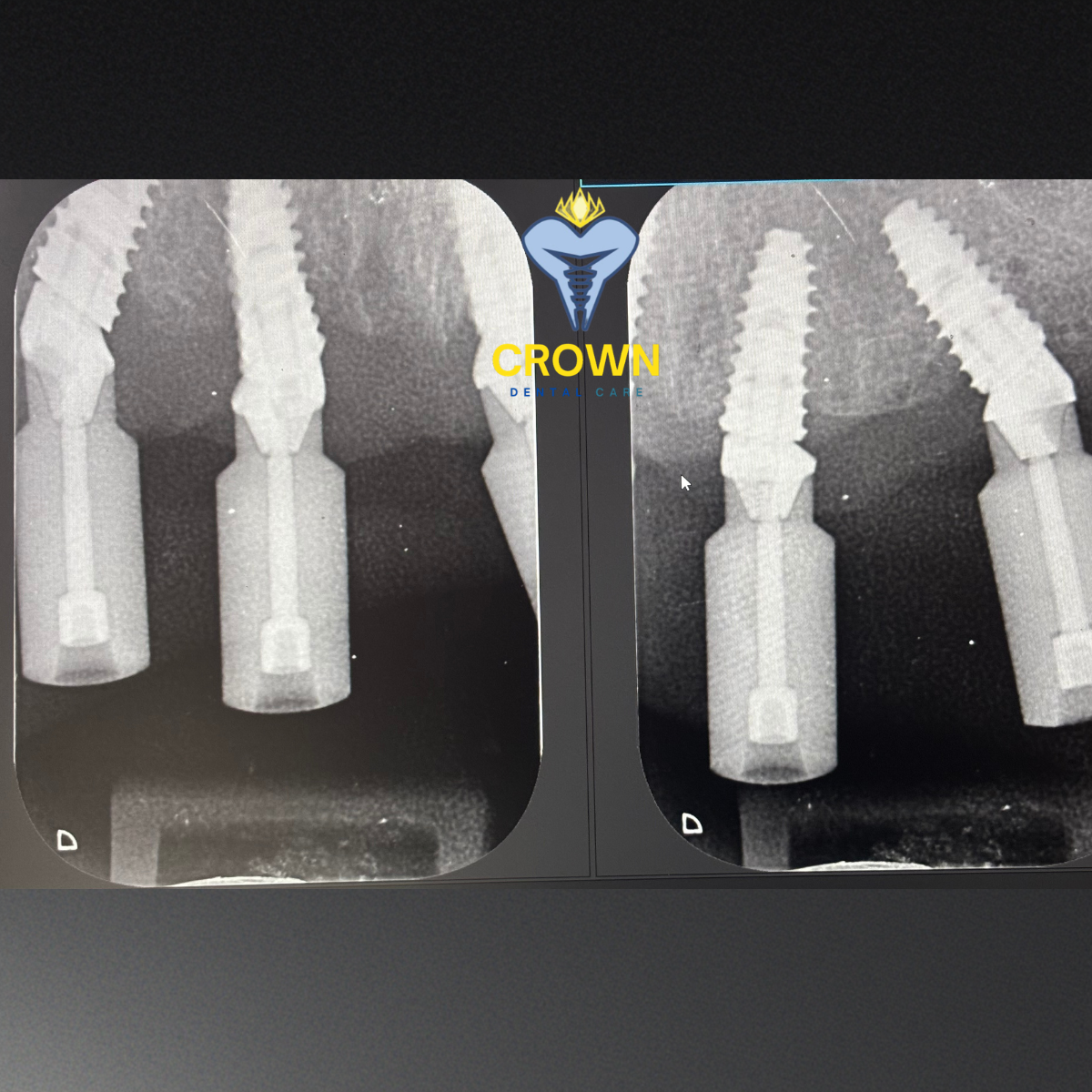Implant Precision X-Ray