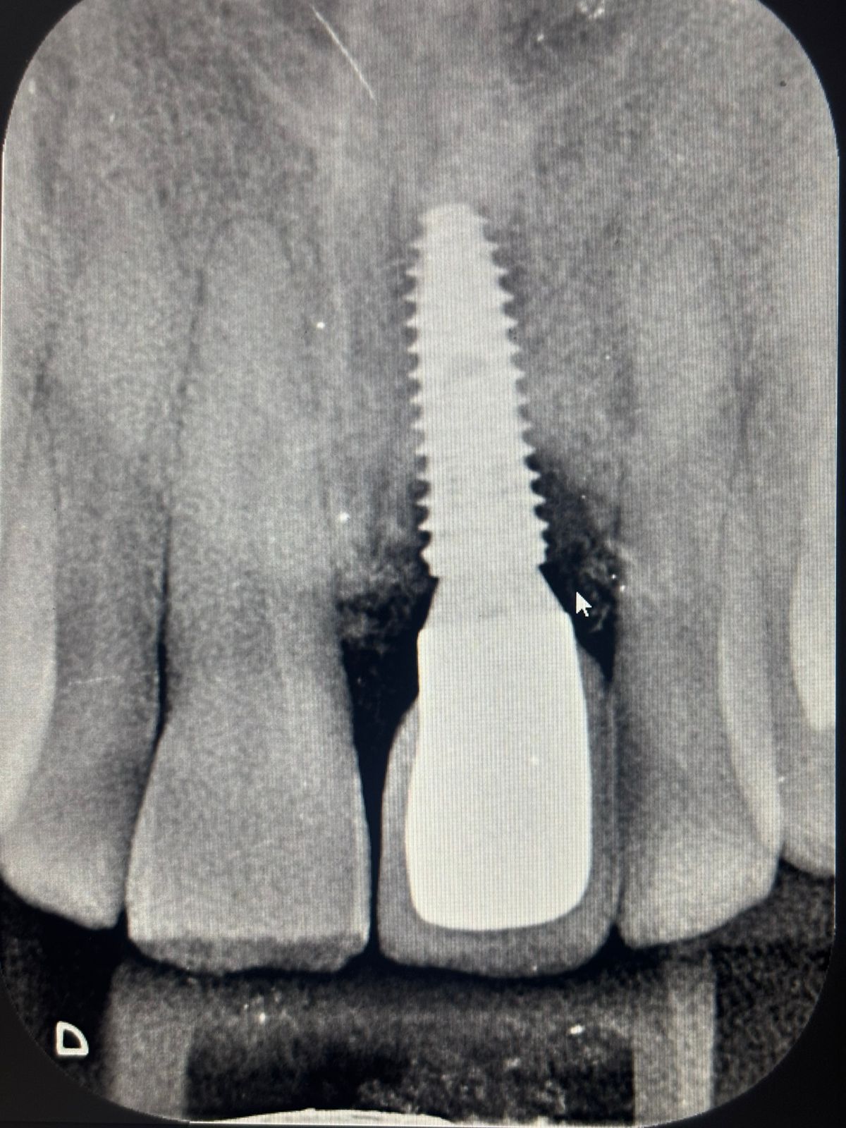 X-ray of patient with implant